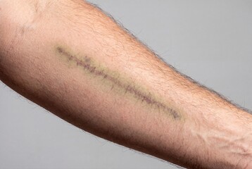 Fototapeta premium Surgical scar on human arm with bruising and healing skin texture