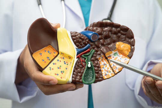 Cirrhosis, Liver cancer, fatty liver, Asian doctor with liver human model.