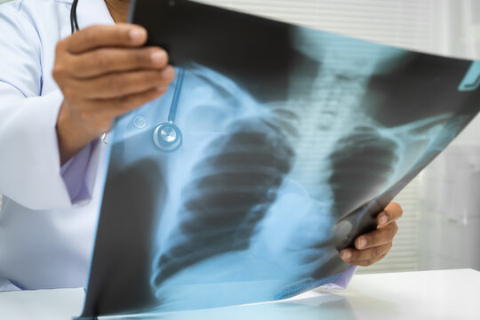 Doctor examining lung radiography xray film.