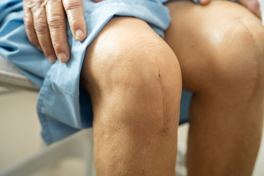 Asian elderly woman patient show her scars surgical total knee joint replacement Suture wound surgery arthroplasty on bed in hospital.