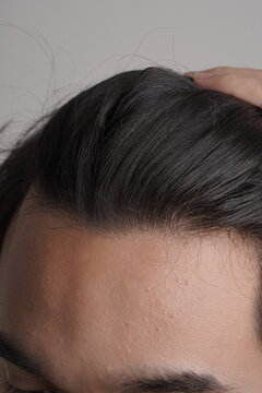 Close-up portrait of young man checking front hairline and scalp health
