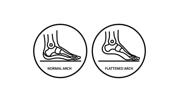 Foot skeletal anatomy diagram comparing a normal arch with a flattened arch in black and white minimalist circle drawings.