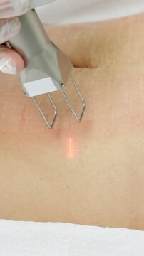 Close up of a beautician's hand in a protective glove performing a fractional co2 laser treatment on a patient's abdominal skin for scar removal and rejuvenation in a cosmetic clinic