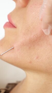 Extreme close up shot of a cosmetologist performing a thread lift, a non surgical facial rejuvenation procedure, on a patient's chin area to contour and lift the skin
