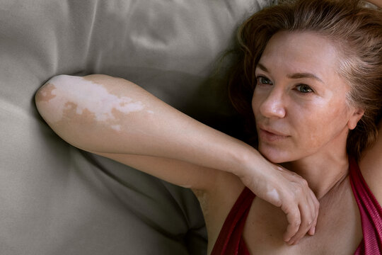 Beautiful mature woman. Middle age famale  with vitiligo skin and gray hair.  Skin with  autoimmune disease. pigmentation