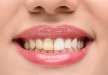 Obraz premium Woman before and after teeth whitening, closeup