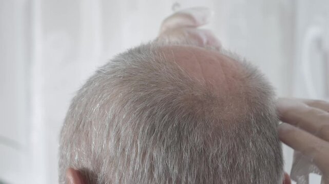 trichologist performs scalp injections vitamins, peptides and amino acids on man's balding area, promoting hair growth, targeting follicle strength and hair restoration