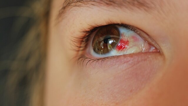 Close-up of a human eye with a subconjunctival hemorrhage showing red blood vessels