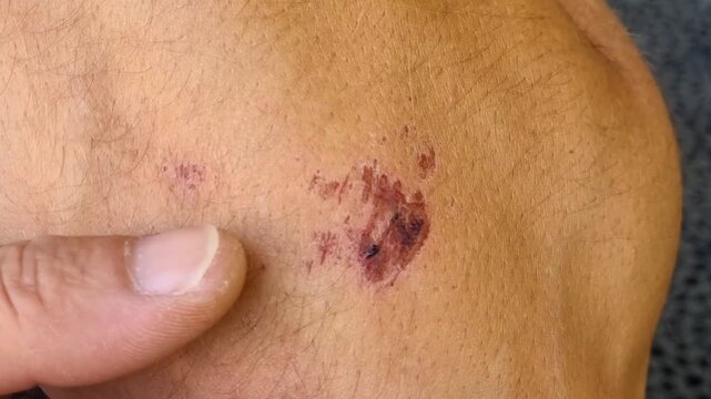 Close-up of a man touching and gently scratching an itchy bruise on his elbow, highlighting skin irritation, discomfort, healing and everyday health