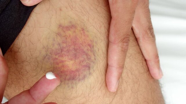 Close up of a man's hand applying ointment on a large on his leg for pain relief