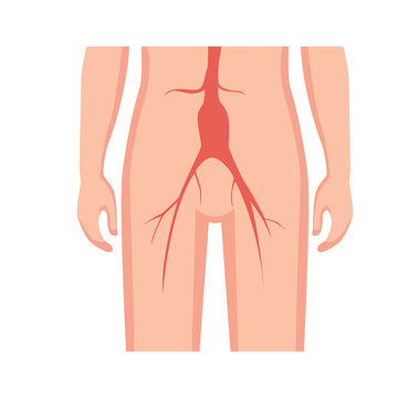 Aortic Aneurysm Types Medical Illustrations