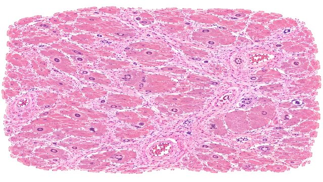 Dilated Cardiomyopathy Histopathology H&E Stained Myocardium Microscopy