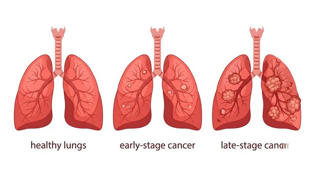 Medical illustration showing the progression of lung damage from a healthy lung to chronic obstructive pulmonary disease stages
