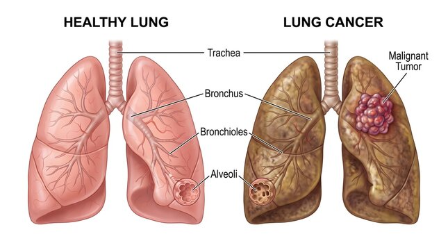 Medical comparison illustration showing the visual difference between a healthy human lung and a diseased cancerous lung organ