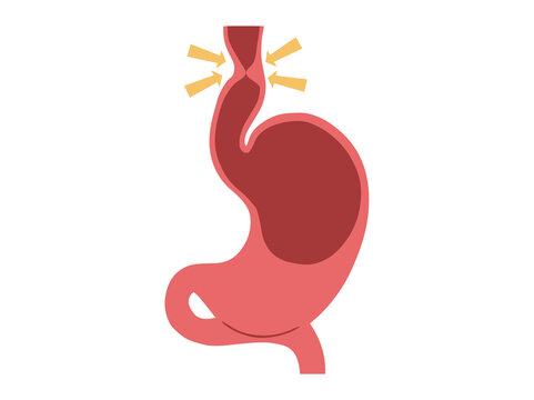 Esophageal Stricture Disease illustration