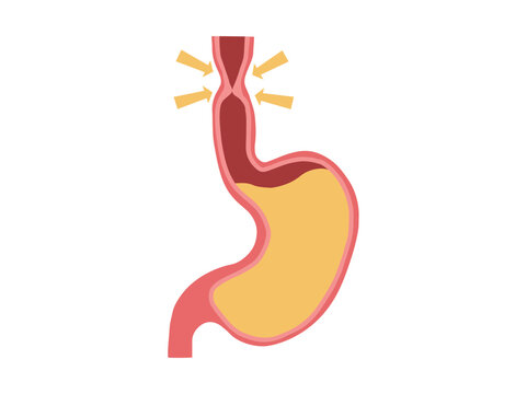 Esophageal Stricture Disease illustration