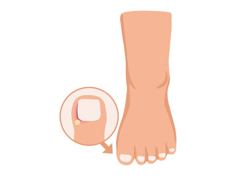 Paronychia Disease in Toenail