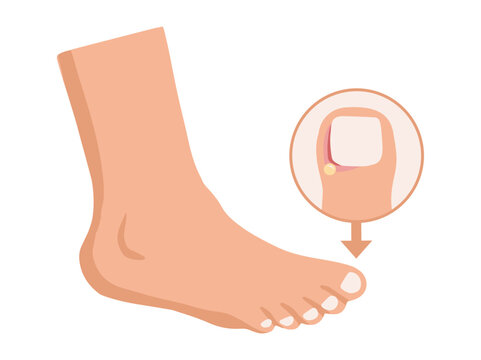 Paronychia Disease in Toenail