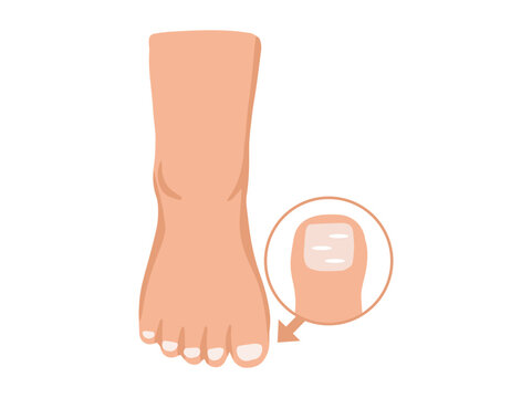 Leukonychia Disease in Toenail