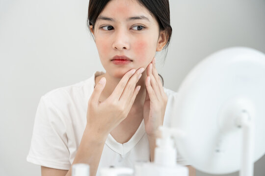 Young woman are worried about faces Dermatology and allergic to steroids in cosmetics. sensitive skin, red face from sunburn, acne, allergic to chemicals, rash on face. skin problems and beauty