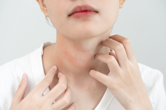 skin problem and beauty. Young woman scratch body has itchy skin from skin allergic, steroid allergy, sensitive skin, red from sunburn, chemical allergy, rash, insect bites, Seborrheic Dermatitis.