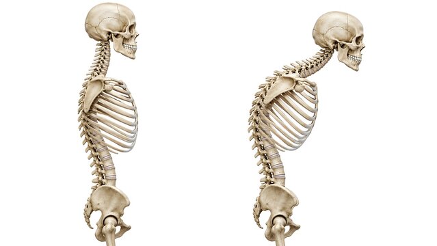 Normal Spine vs Kyphosis Human Skeleton Side View Isolated on White Background