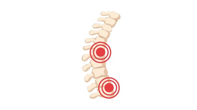 animation of spinal pain and herniated disc concept