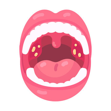 Close up medical illustration of an open mouth displaying inflamed tonsils, uvula, and characteristic white deposits within the throat.
