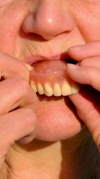 dentures dentistry elderly woman removes and reinserts dental prosthesis while smiling naturally. The scene highlights oral health, modern dentistry, dental care and quality of life for seniors.