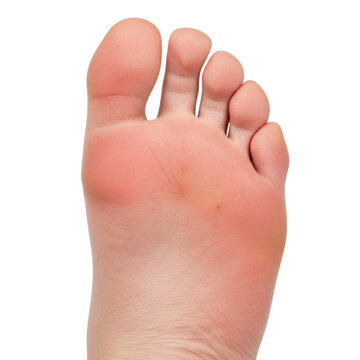 extreme close-up side profile of an adult foot sole, hyper-realistic texture showing severe localized redness, swelling, and inflammation on the ball and heel, clinical study of pathology