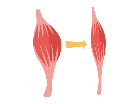Normal Muscular and Dystrophy Atrophy