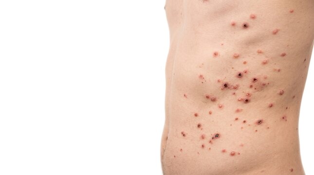 Side view of male torso with viral skin rash blisters and lesions