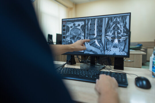 Medical professional analyzing a spine MRI scan on a computer screen in a hospital, pointing at a lumbar disc hernia during a diagnostic examination for back pain. neurosurgeon working at a computer