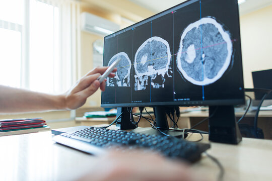 professional neurosurgeon is working at a computer. hand points with a pen at a computer monitor displaying multiple cross-section brain CT scans showing a large tumor, diagnostic review