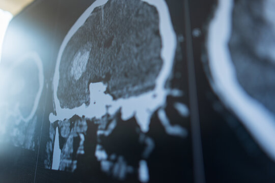 close-up view of a computer screen displaying a medical brain CT scan with a visible large tumor, hematoma, or stroke lesion for diagnostic radiology analysis.