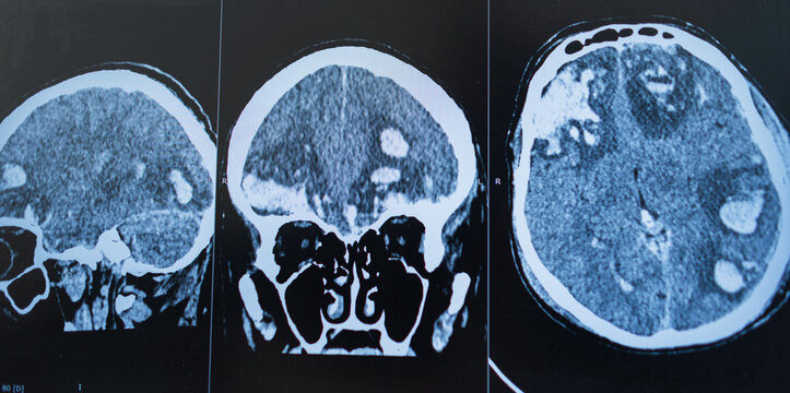 Medical brain CT scan showing sagittal, coronal, and axial views with severe intracranial hemorrhage, traumatic brain injury, or multiple metastatic tumors for diagnostic radiology review.