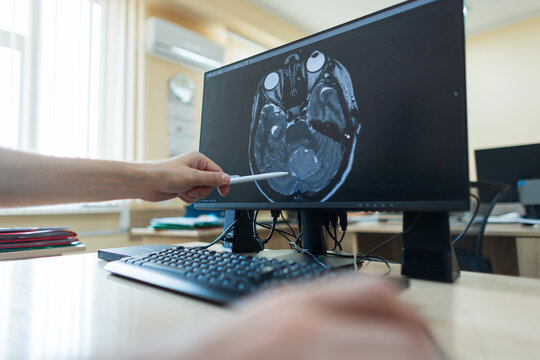 professional neurosurgeon is working at a computer. hand points with a pen at a computer monitor displaying an axial brain MRI scan showing the cerebellum and eyeballs during a diagnostic consultation