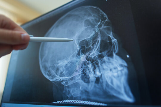close-up of a doctor's hand pointing with a pen at a computer monitor screen displaying a lateral x-ray radiograph of a human skull during a medical or dental diagnosis.