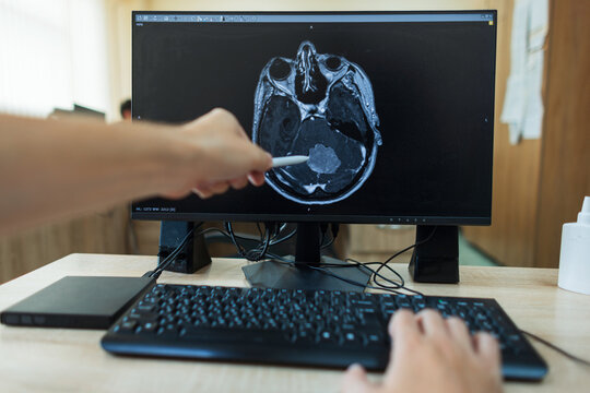 doctor's perspective as they point with a pen at a computer screen displaying an axial brain MRI scan with a large tumor in cerebellum during a medical diagnostics review. professional neurosurgeon