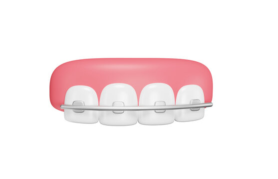 Teeth braces 3d icon. Orthodontic treatment, dental alignment and oral healthcare concept. Isolated 3D object.