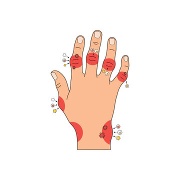 Medical illustration of a hand showing signs of gout inflammation with red swollen joints and tophi