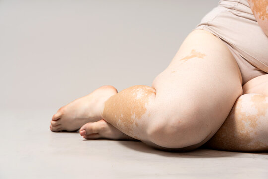 Woman showing vitiligo skin condition on body, promoting self-love and diversity