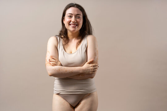 Woman with vitiligo embracing her skin, promoting body positivity and self-acceptance