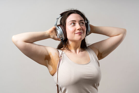 Woman with vitiligo enjoying music on headphones, embracing diversity and body positivity