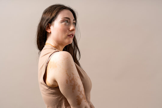 Woman with vitiligo representing body positivity and skin diversity