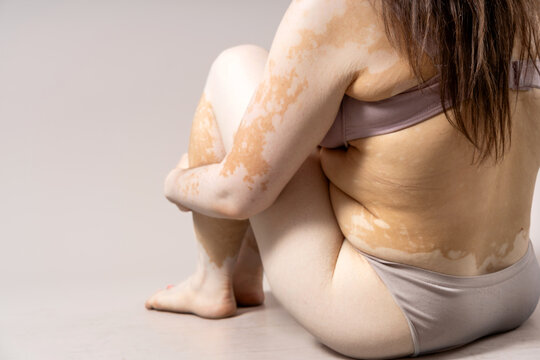 Woman with vitiligo embracing body diversity and unique skin pigment condition