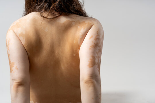 Woman's back featuring vitiligo with depigmented patches on skin and arms