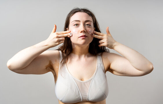 Woman with vitiligo applying face cream for skin care routine