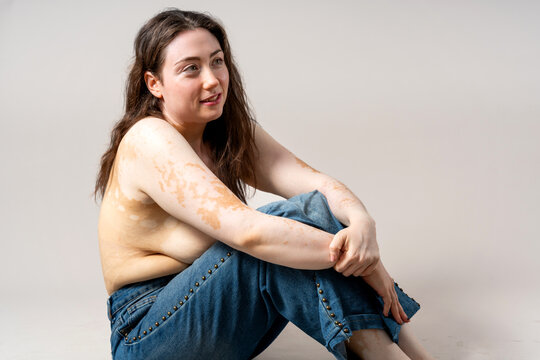 Woman with vitiligo representing body positivity and natural beauty