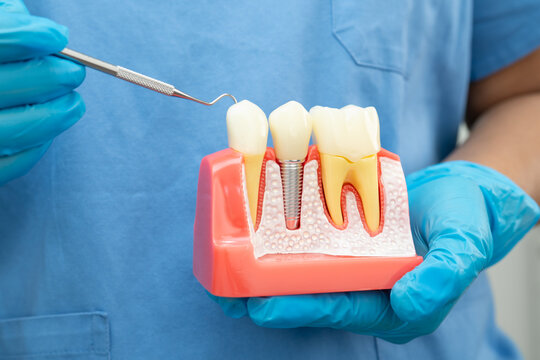 Dental implant, artificial tooth roots into jaw, root canal of dental treatment, gum disease, teeth model for dentist studying about dentistry.